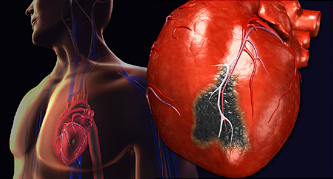 What happens during a heart attack? Is there a way to reverse coronary disease?